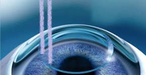 Laser Refractive Surgery - Video
